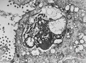 M,33y. | microsporidiosis (or cryptosporidiosis) - duodenum-posttransplantation immunodeficiency